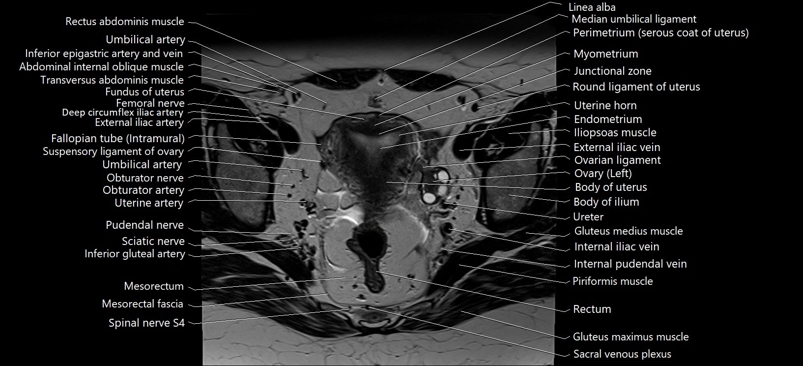 Axial cross sectional anatomy of female pelvis (MRI 3T) image 16.webp
